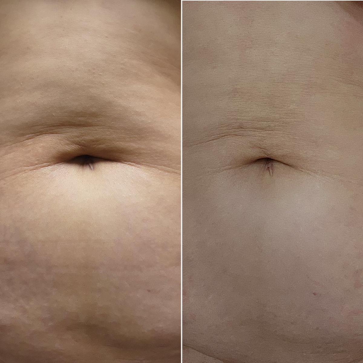 ILJAK Body Firming Cream